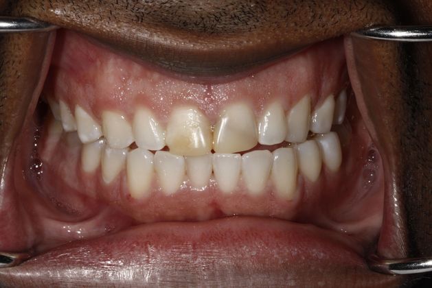 Before treatment