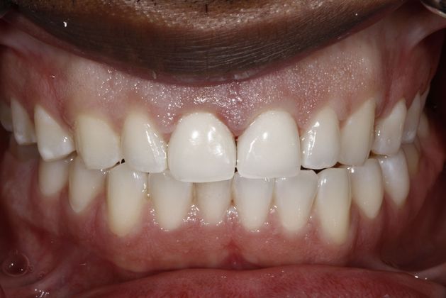 After treatment